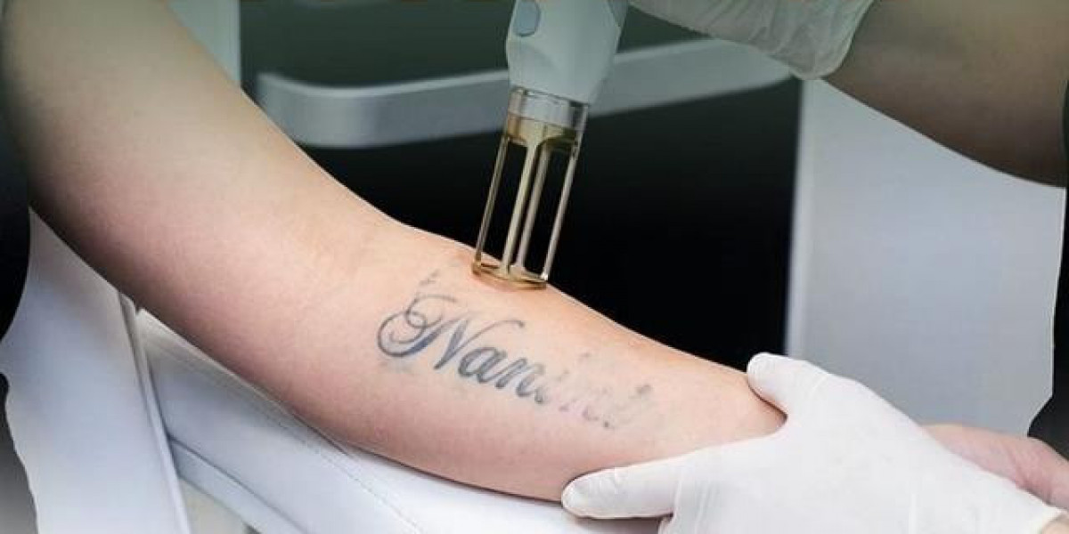 Laser Tattoo Removal in Dubai: What to Expect from Your First Session