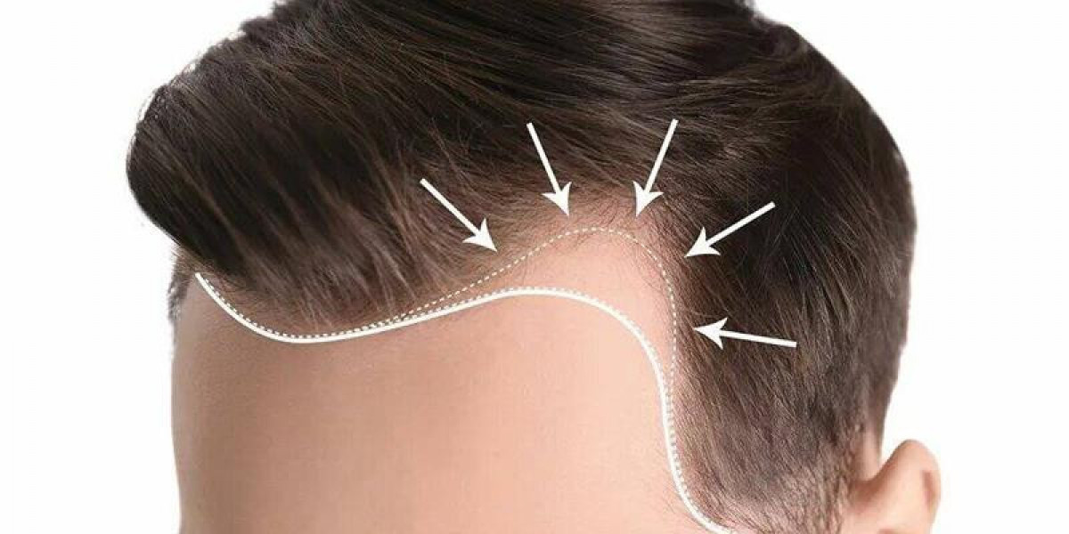 FUE vs FUT Hair Transplant in Dubai: Key Differences Explained