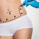 tummytuck saudia