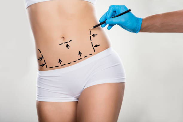 tummytuck saudia