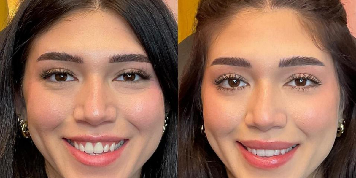 Nasenoperation Schweiz: Moderne Methoden, Vorteile und umfassende Informationen