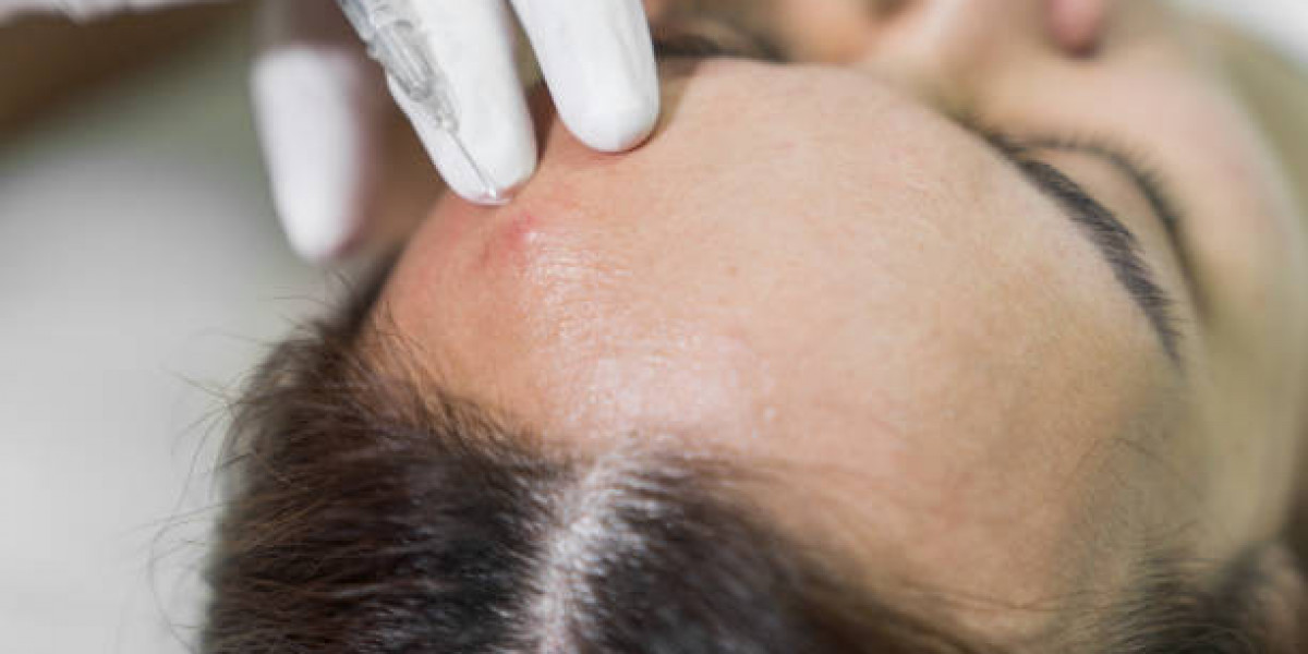 Managing Expectations from PRP Hair Sessions in Riyadh