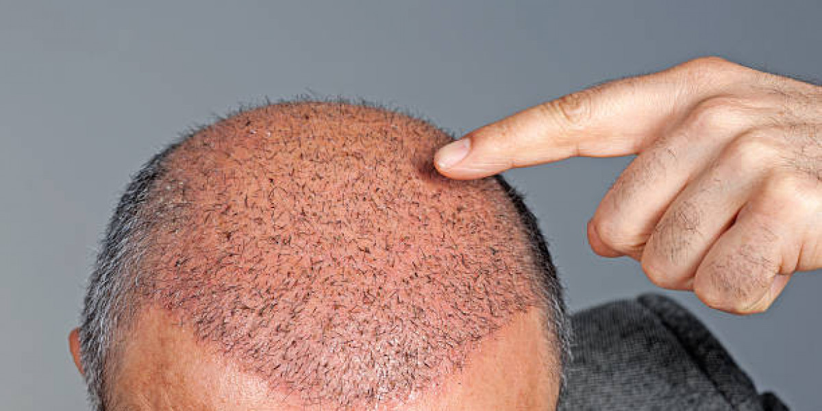 Hair Transplant Advancements in Modern Hair Loss Treatment
