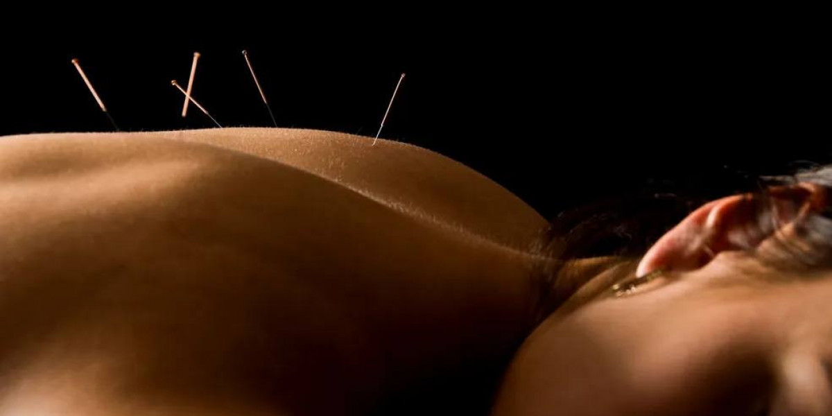 Acupuncture For Back Pain NYC