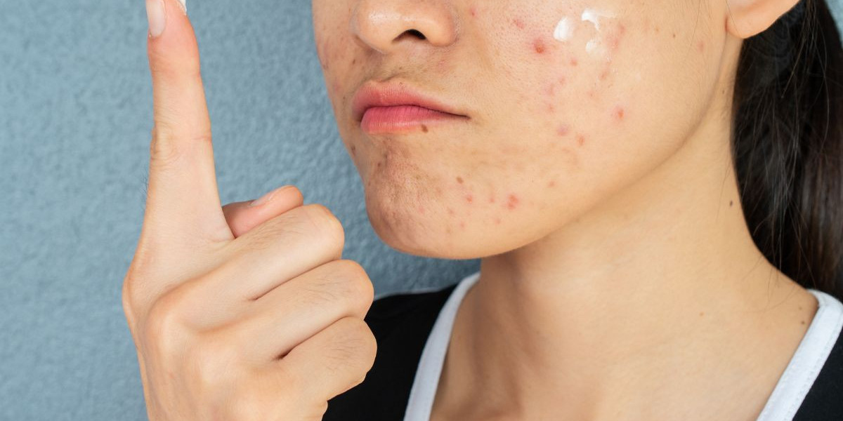 Why Adult Acne Is Rising — And The Treatments That Fix It Fast