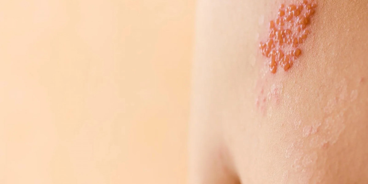 Shingles (Herpes Zoster): Early Signs, Causes, Treatment & Prevention Tips