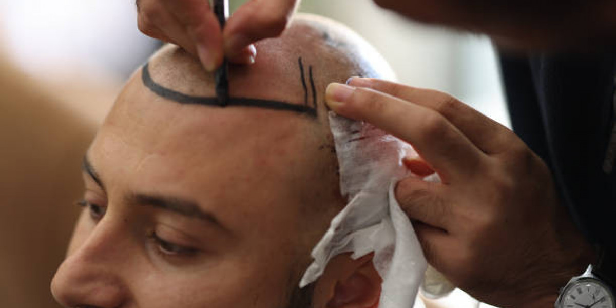 Hair Transplant Tips for Managing Hair After Restoration Surgery