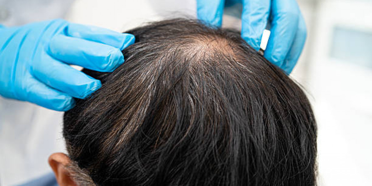 How Exosome Therapy Targets Hair Loss at a Cellular Level
