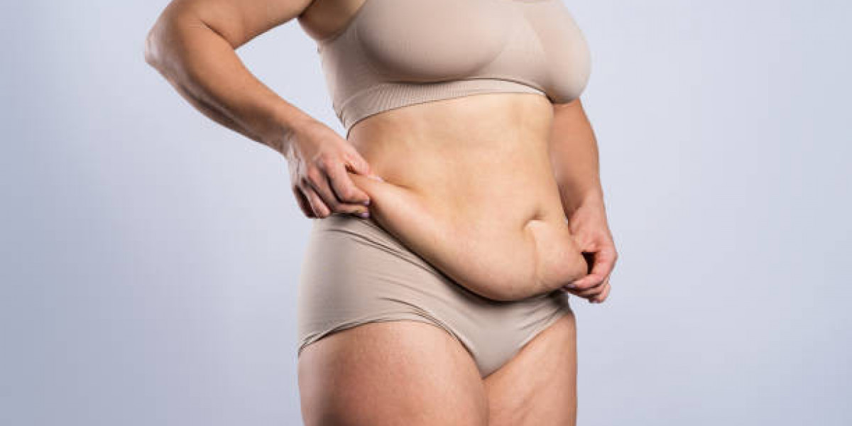 Tummy Tuck Recovery Timeline and Tips for Riyadh Patients