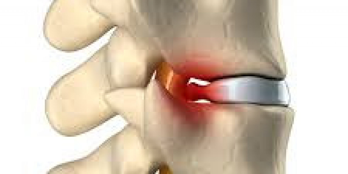 Get Relief from Back Pain with Advanced Slipped Disc Treatment in Faridabad