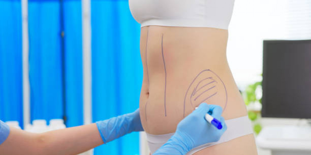 The Future of Liposuction: Innovations and Trends