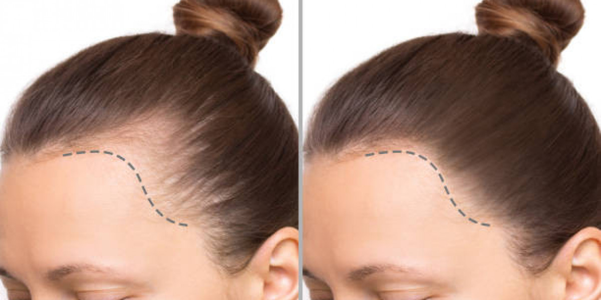 Key Factors Influencing Hair Transplant Success in Riyadh