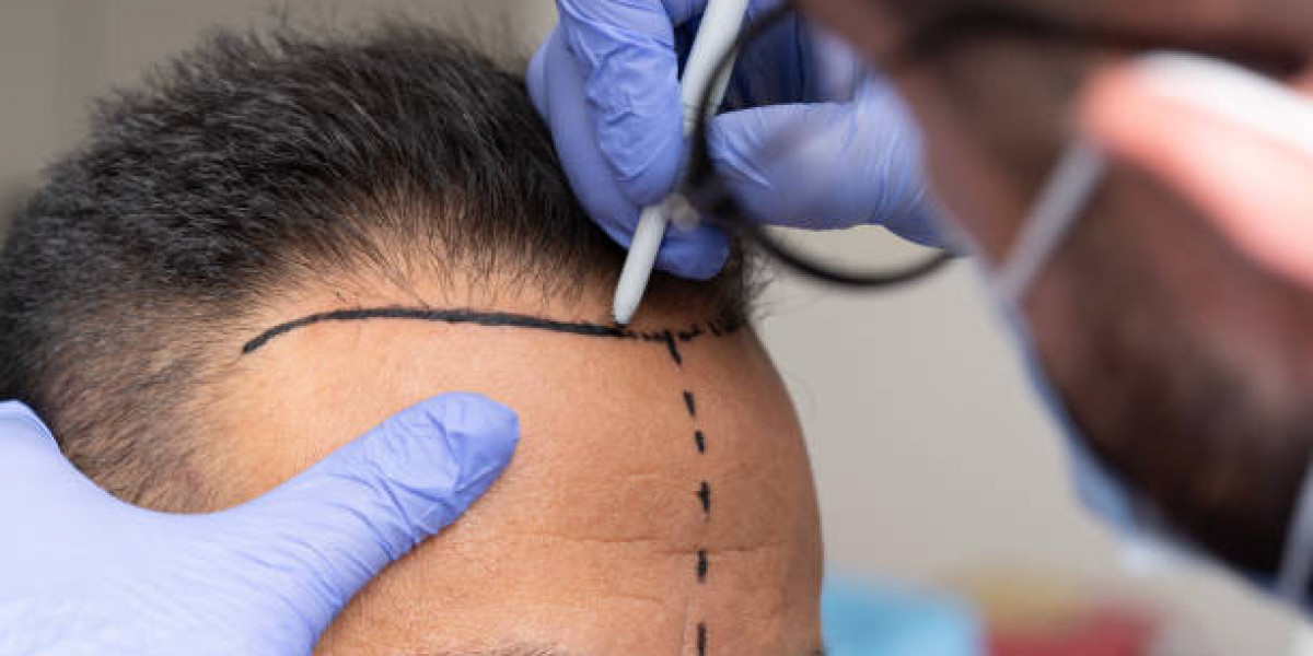 Hair Transplant Healing Guide for Successful Recovery